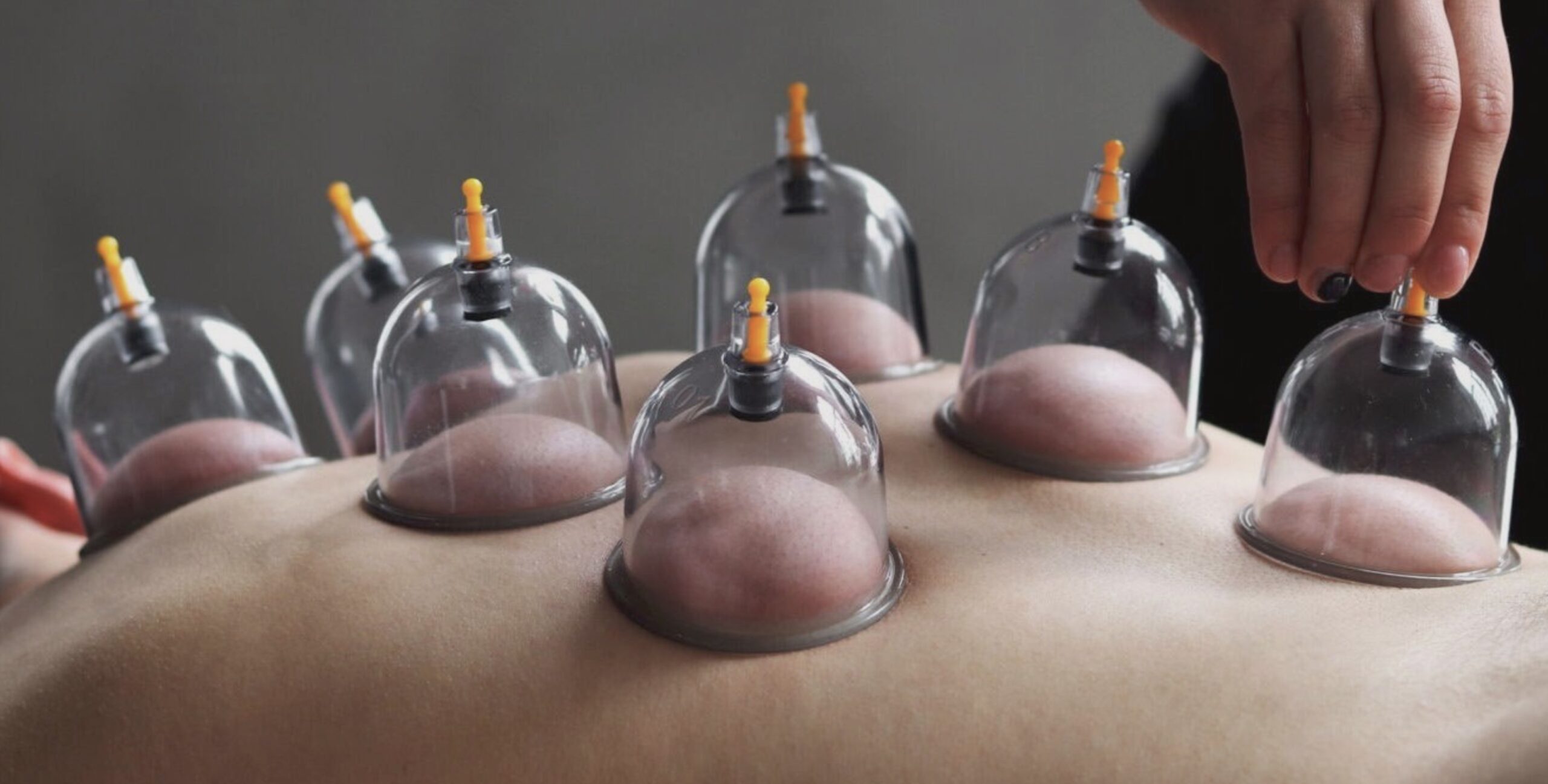 Cupping Therapy Koh Phangan